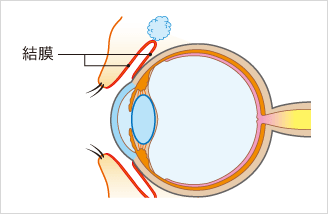 アレルギー性結膜炎